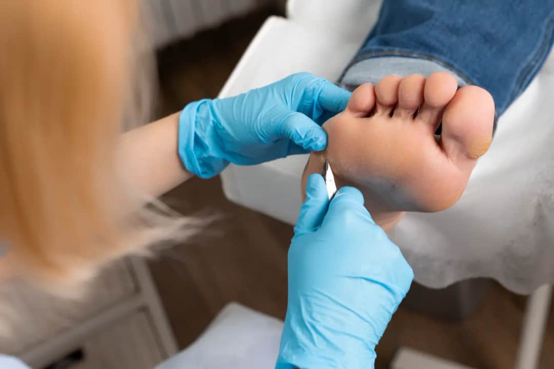 Brodawki wirusowe: kiedy leczenie domowe szkodzi, a kiedy potrzebny jest podolog